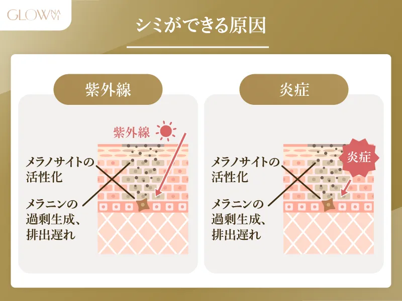 メンズ　シミができる原因